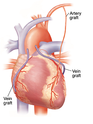 Front view of heart showing two vein grafts and one artery graft.