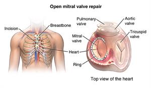 Front view of male chest showing sternal incision. Top view of heart showing mitral valve repair with a ring.