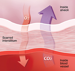 Closeup view of interstitial tissue in lung showing impaired gas exchange between alveolus and capillary because of interstitial lung disease.