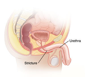Side view cross section of male anatomy showing intestines, rectum, bladder, prostate, penis, testis, urethra, and stricture in urethra.