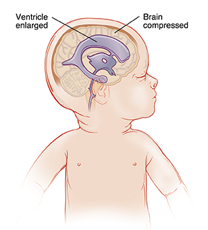 Side view of baby's head showing enlarged ventricles compressing brain.