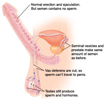 Side view of male reproductive system showing path of sperm after vasectomy.