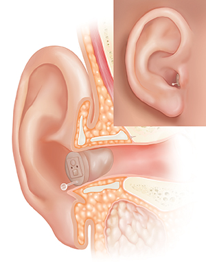 Cross section of ear showing outer, inner, and middle ear structures with completely-in-canal hearing aid in place with inset of external view.