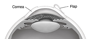 Cross section of eye showing flap in cornea.
