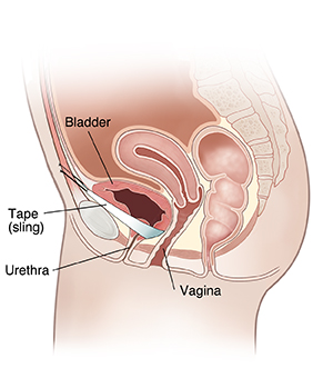 Side view cross section of female pelvis showing pubovaginal sling.