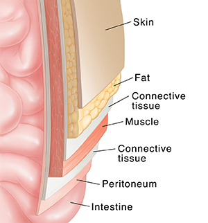 Corte transversal de una pared abdominal sobre el intestino que muestra distintas capas: piel, grasa, fascia, músculo y peritoneo.