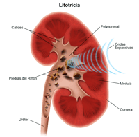 Ilustración de la litrotricia