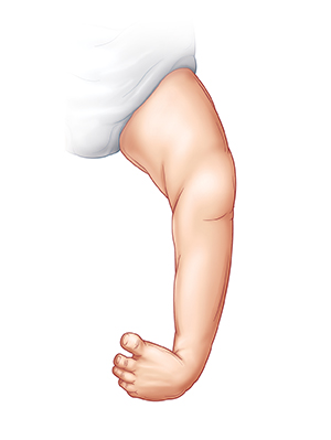 Outline of baby's leg showing clubfoot turned inward.