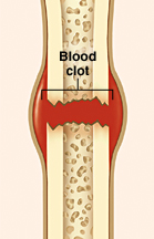 Cross section of broken bone showing blood clot forming at break.