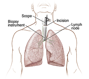 Front view of chest showing scope inserted into chest through incision.