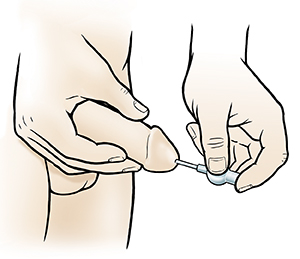 Man inserting pellet into urethra.