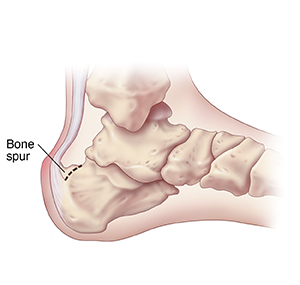 Side view of foot showing bone spur on heel. 