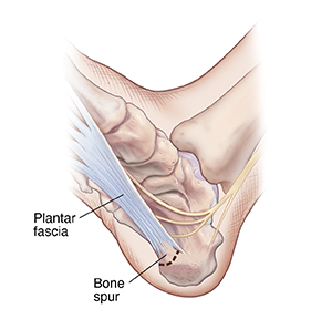 Bottom view of foot showing bone spur on heel near plantar fascia.