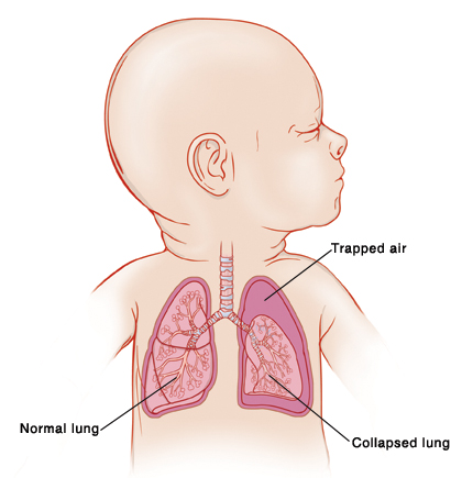 Closeup of baby with head turned to side showing airway and lungs. Left lung has trapped air around it, and lung is collapsed.