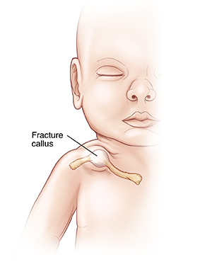 Front view of baby showing fracture callus on clavicle.