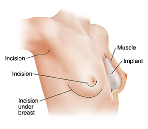 Three-quarters view of female chest showing breast implant incisions on right and cross section of left breast showing implant in place.