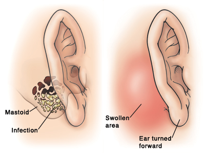 Side view of ear showing infection in mastoid bone. SIde view of ear showing swollen area behind ear, pushing ear forward.