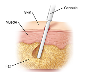Skin layers showing cannula removing fat during liposuction.