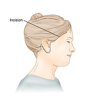 Side view of woman's head showing incision for rhytidectomy (facelift).