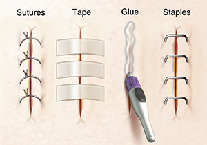 Four incisions showing closures with sutures, steri-strips, surgical glue, and staples.