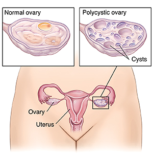 Front view of female reproductive tract with insets showing normal ovary and polycystic ovary.