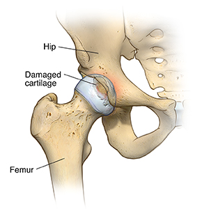 Front view of hip joint showing osteoarthritis.