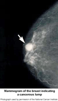 Click Image to Enlarge Picture of mammogram of the breast indicating a cancerous lump