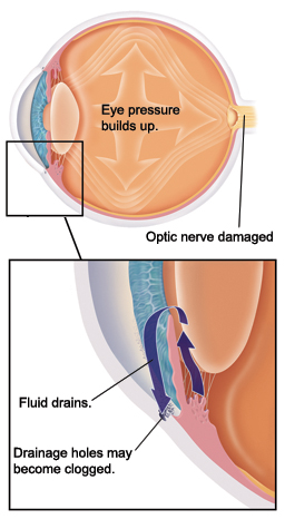 Side view of eye with arrows inside showing pressure building up. Optic nerve at back of eye is damaged. Closeup of cross section of eye where cornea covers iris. Pupil is opening in center of iris. Lens is behind iris. Fluid drains from behind iris through pupil to front of iris. Fluid then drains out of eye through holes near cornea. Drainage holes may become clogged.