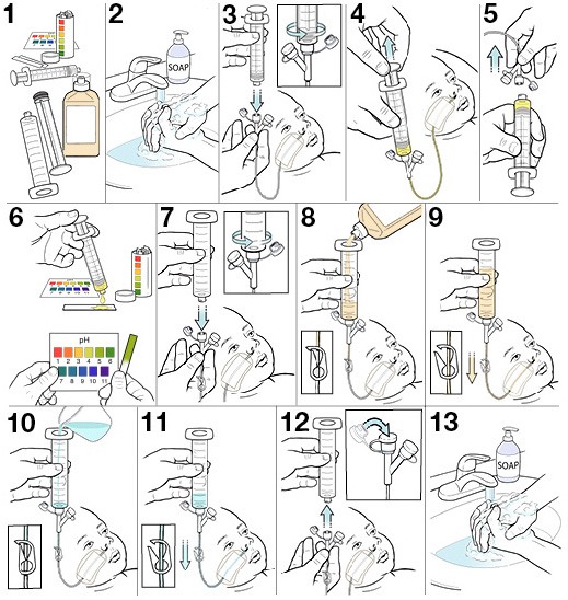 13 steps for using an NG tube to feed your baby