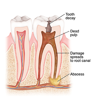 Cross section of tooth with decay, dead pulp, and abscess.
