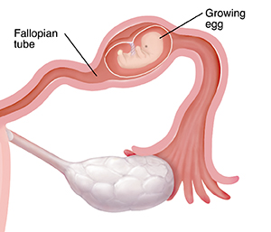 Closeup cross section of fallopian tube with embryo growing inside in ectopic pregnancy.