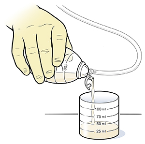 Closeup of gloved hand pouring fluid from drainage bulb into measuring flask.