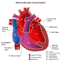 Anatomy of a heart with an atrioventricular canal defect