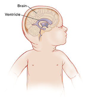 Side view of infant's head showing brain and ventricle.