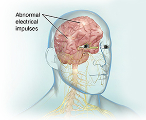 Front view of brain and spinal cord with epileptic brain activity.