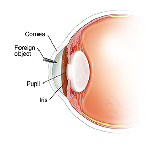 Side view cross section of front of eye showing iris, pupil, and foreign object stuck in cornea.