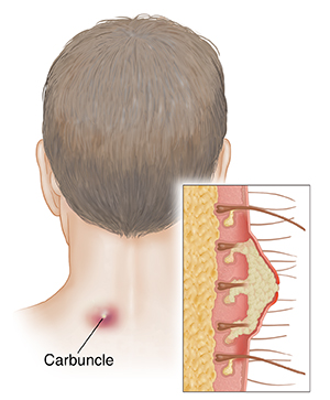 Back view of man's head and neck with carbuncle on neck. Inset shows cross section of carbuncle.