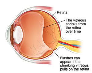 Three-quarter view of cross-sectioned eye showing shrinking vitreous pulling on retina.