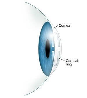 Side view of eye showing corneal ring in cornea.