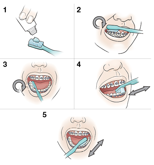 5 steps in brushing teeth and braces