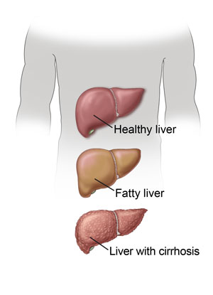 Healthy liver, fatty liver, liver with cirrhosis