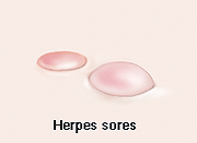 Herpes sores