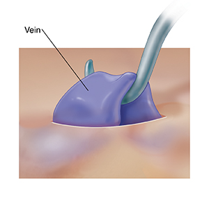 Closeup of hook pulling vein through skin incision.