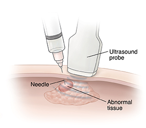 Closeup of needle inserted into abnormal tissue for biopsy. Ultrasound probe on skin surface.