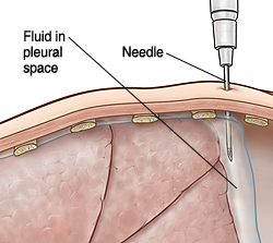 Cross section of body wall showing needle removing pleural fluid.