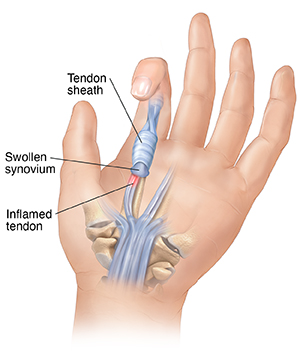 Palm view of hand showing anatomy of trigger finger.