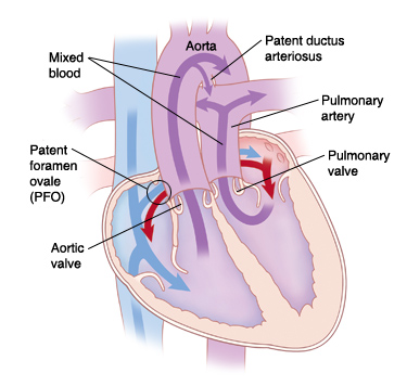 Front view cross section of heart showing transposition of the great arteries. Aorta is over right ventricle, and pulmonary artery is over left ventricle. There is also patent ductus arteriosus and patent foramen ovale (PFO). Arrows show blood flowing both ways between left and right heart through PFO. Mixed blood flows out of heart through aorta and pulmonary artery.