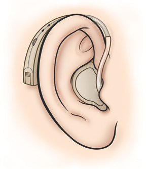 Ear showing hearing aid in ear canal with part of hearing aid behind the ear.