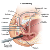 Illustration of cryotherapy procedure