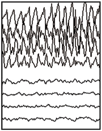 Partial seizure EEG tracing.